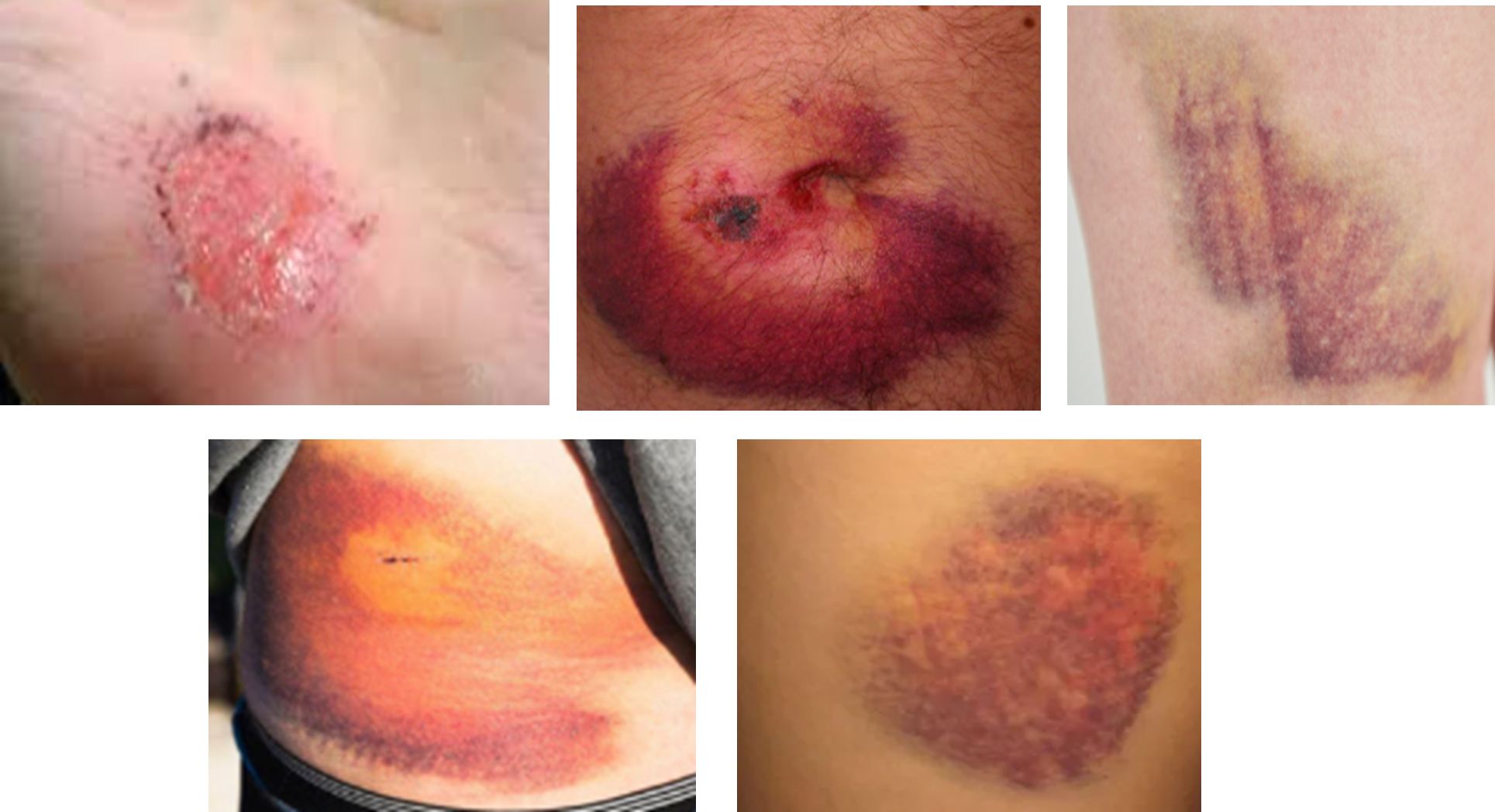 Fig (1) Sample images representing blunt force injuries