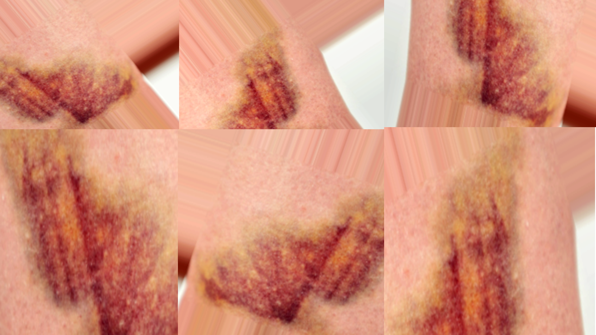 Fig (5) Augmented images of blunt force injuries